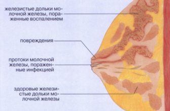 lactostase mammaire