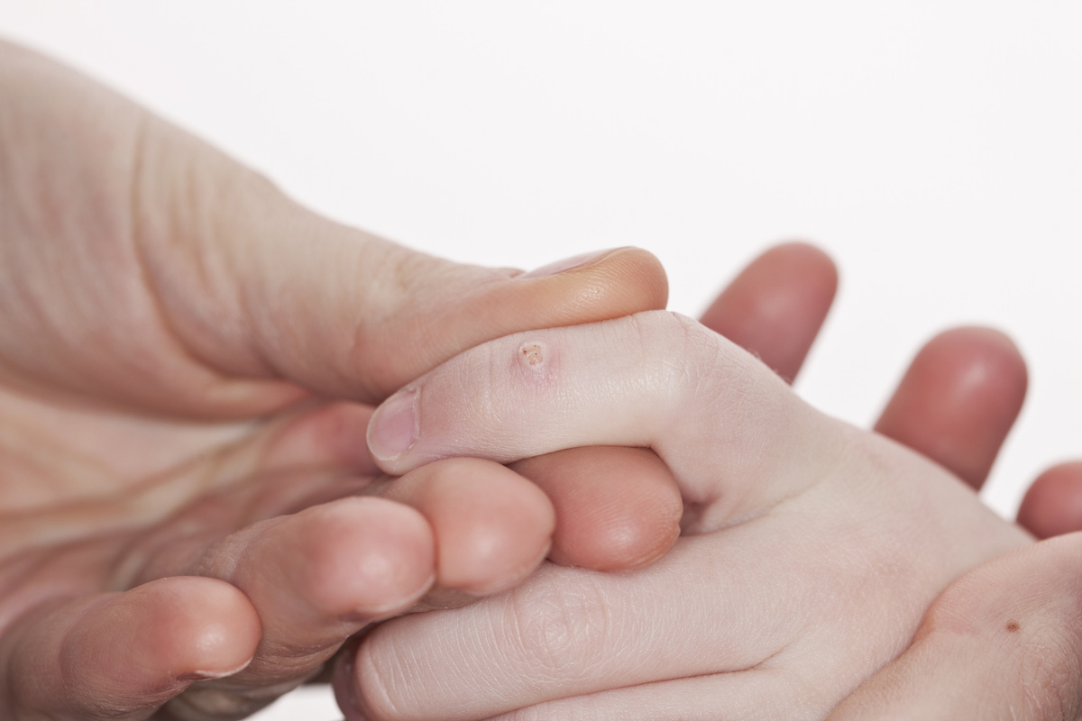 un enfant a des verrues